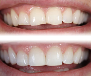 faccette-dentali
